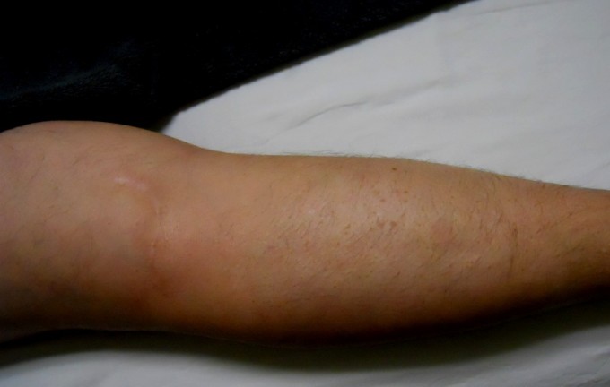 Science of Massage Institute » News from the Clinic Mystery Foot Numbness