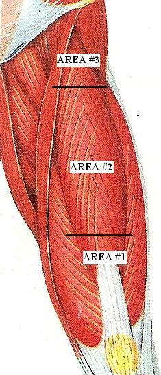 Fig. 1. Kneading of the rectus femoris muscle