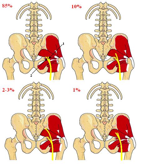 Fig.4. Sciatic nerve and PM