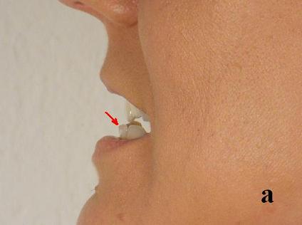 Fig.1a. Mandibular protrusion bite