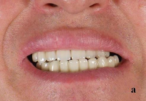 Fig.2a. Pathological bite