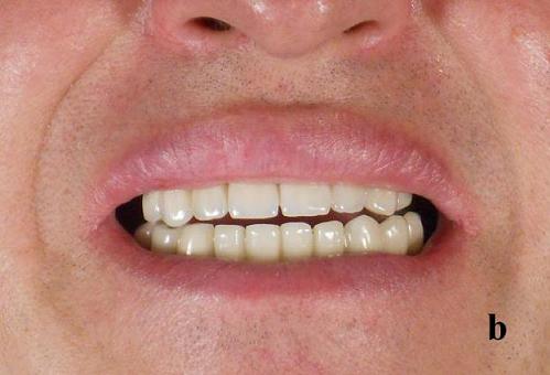 Fig.2b. Restored normal bite