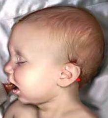 Fig. 1. Point of the vertebral artery