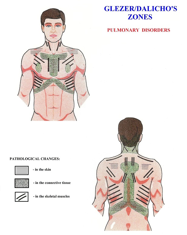 Fig. 4. Glezer/Dalicho zones in cases of pulmonary disorders