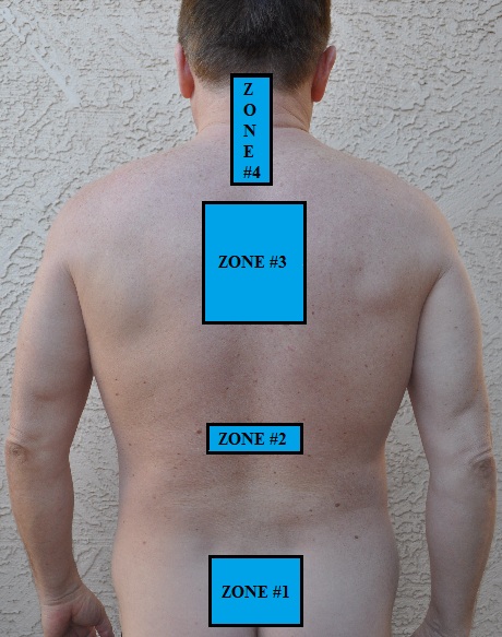 Fig. 1. Pattern of CTZs distribution in patients with CH