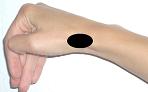 Pain pattern for De Quervain's Disease Styloiditis of the Radius