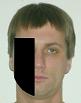 Pain pattern for Bell's Palsy Facial Nerve Neuralgia