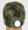 Pain pattern for Headache Greater Occipital Nerve Neuralgia
