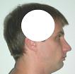 Pain pattern for TMJ Temporomandibular Joint Dysfunction Tinnitus
