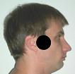 Pain pattern for TMJ Temporomandibular Joint Dysfunction