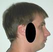 Pain pattern for TMJ Temporomandibular Joint Dysfunction