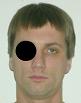 Pain pattern for Headache Greater Occipital Nerve Neuralgia Trigeminal Nerve Neuralgia