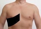 Pain pattern for Intercostal Nerve Neuralgia
