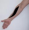 Pain pattern for Musculocutaneous Nerve Neuralgia Anterior Scalene Muscle Syndrome Pectoralis Minor Muscle Syndrome