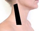 Pain pattern for Anterior Scalene Muscle Syndrome Thoracic Outlet Syndrome