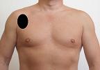 Pain pattern for Pectoralis Minor Muscle Syndrome