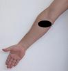 Pain pattern for Pronator Teres Muscle Syndrome Median Nerve Neuralgia