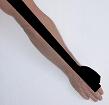 Pain pattern for Radial Nerve Neuralgia Anterior Scalene Muscle Syndrome Pectoralis Minor Muscle Syndrome