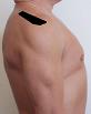 Pain pattern for Rotator Cuff Syndrome Trapezius Muscle Syndrome