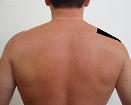 Pain pattern for Rotator Cuff Syndrome Trapezius Muscle Syndrome