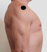 Pain pattern for Subacromial Bursitis