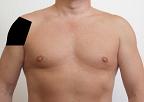 Pain pattern for Deltoid Muscle Syndrome Axillar Nerve Neuralgia Anterior Scalene Muscle Syndrome