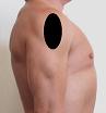 Pain pattern for Deltoid Muscle Syndrome Axillar Nerve Neuralgia Anterior Scalene Muscle Syndrome