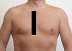 Pain pattern for Intercostal Nerve Neuralgia