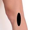 Pain pattern for Lateral Epicondylitis of the Femur and Tibia Tensor Fasciae Latae Muscle Syndrome Tension in the Iliotibial Tract Knee Osteoarthritis