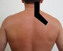 Pain pattern for Levator Scapulae Muscle Syndrome Cervical Pain Cervicocranialgia