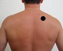 Pain pattern for Levator Scapulae Muscle Syndrome