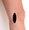 Pain pattern for Medial Epicondylitis of the Femur and Tibia Knee Osteoarthritis
