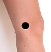 Pain pattern for Injury of the Medial Collateral Ligament (MCL) of the Knee Medial Epicondylitis of the Femur