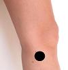 Pain pattern for Injury of the Medial Collateral Ligament (MCL) of the Knee Medial Epicondylitis of the Tibia