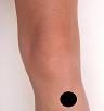 Pain pattern for Osgood-Schlatter Disease