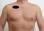 Pain pattern for Pectoralis Major Muscle Syndrome