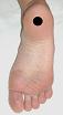 Pain pattern for Heel Pain Calcaneal Spur Syndrome