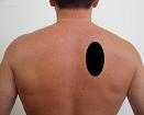 Pain pattern for Rhomboideus Major and Minor Muscle Syndrome Trapezius Muscle Syndrome