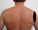 Pain pattern for Rotator Cuff Syndrome Deltoid Muscle Syndrome