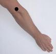 Pain pattern for Tennis Elbow Lateral Epicondylitis of the Humerus