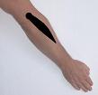 Pain pattern for Extensor Digitorum Muscle Syndrome Tennis Elbow
