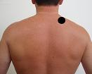 Pain pattern for Trapezius Muscle Syndrome