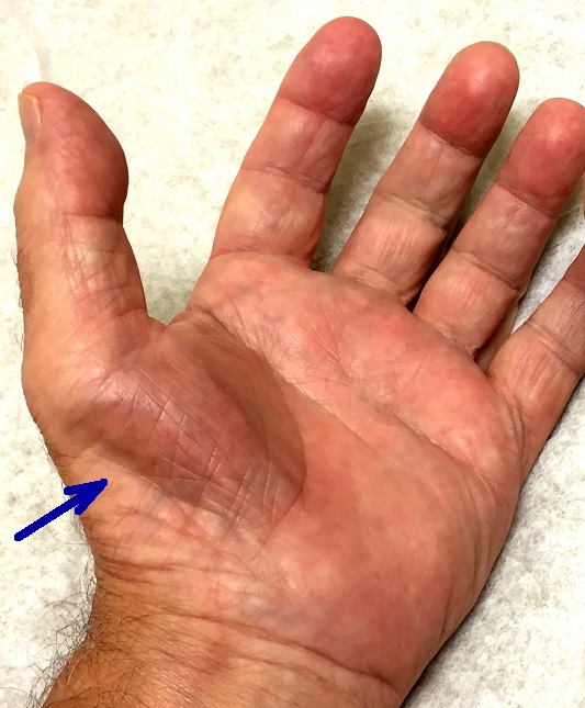CARPAL-ATROPHY2a