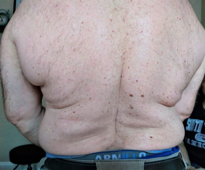 Posterior view of the patient’s back