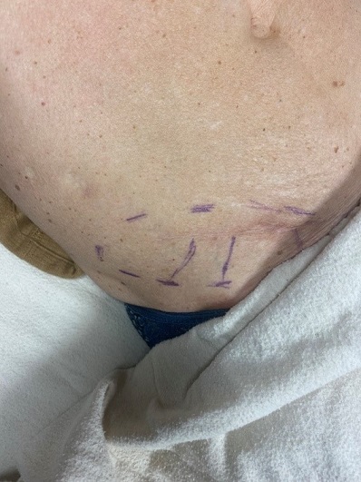 Patient’s anterior thigh with marked sensory recovery areas