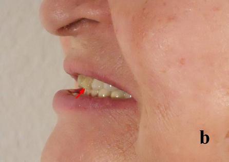Fig.1b. Maxillary protrusion bite