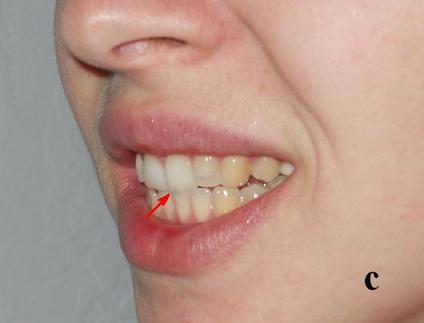 Fig.1c. Insial bite