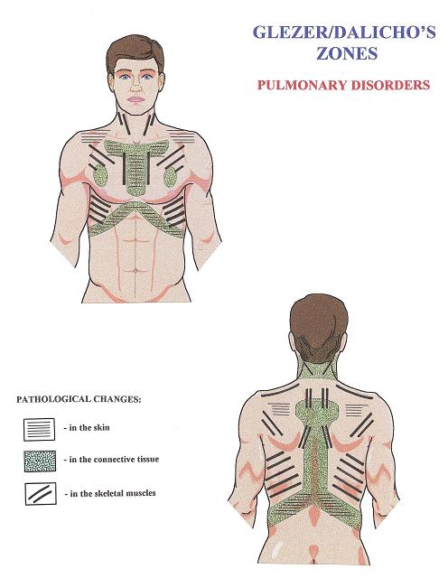Diagram 4. Gläser/Dalicho zones in cases of chronic pulmonary disorders.