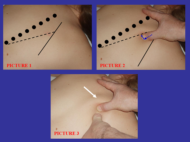 Fig. 1. Mobilization of the trapezius muscle to work on the rhomboid major muscle