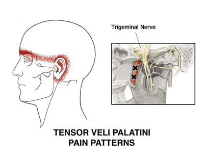 Fig. 1. Pain pattern for m. tensor veli palatini